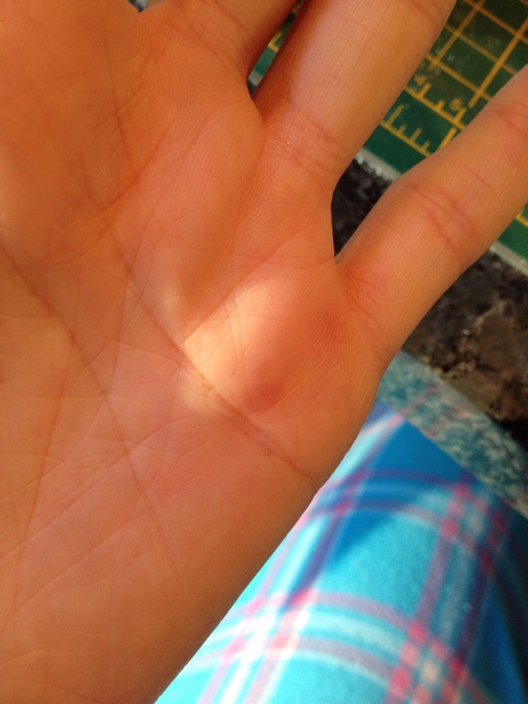 Blisters